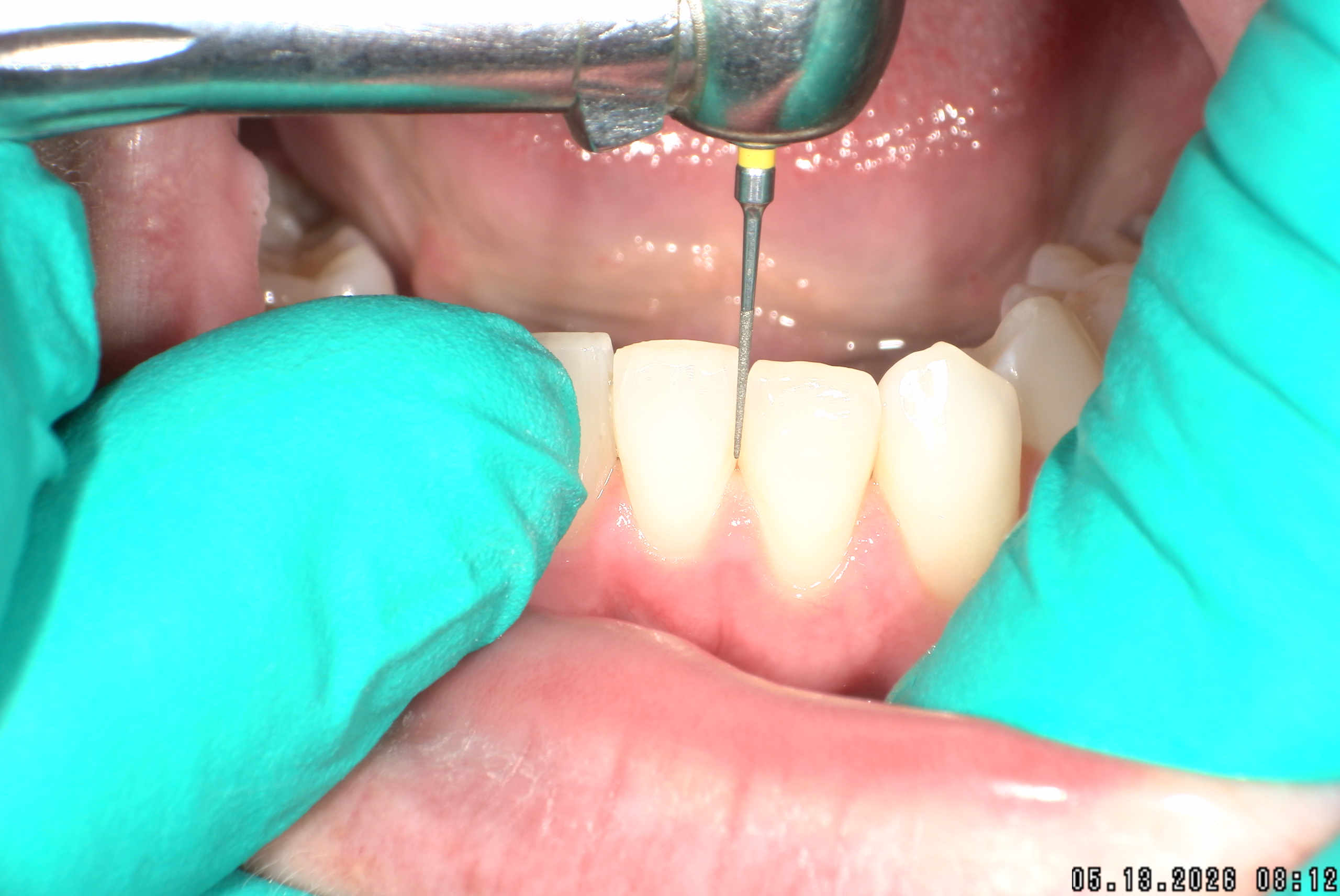 Watson-ProxiBur for Clear Aligner Treatment-image