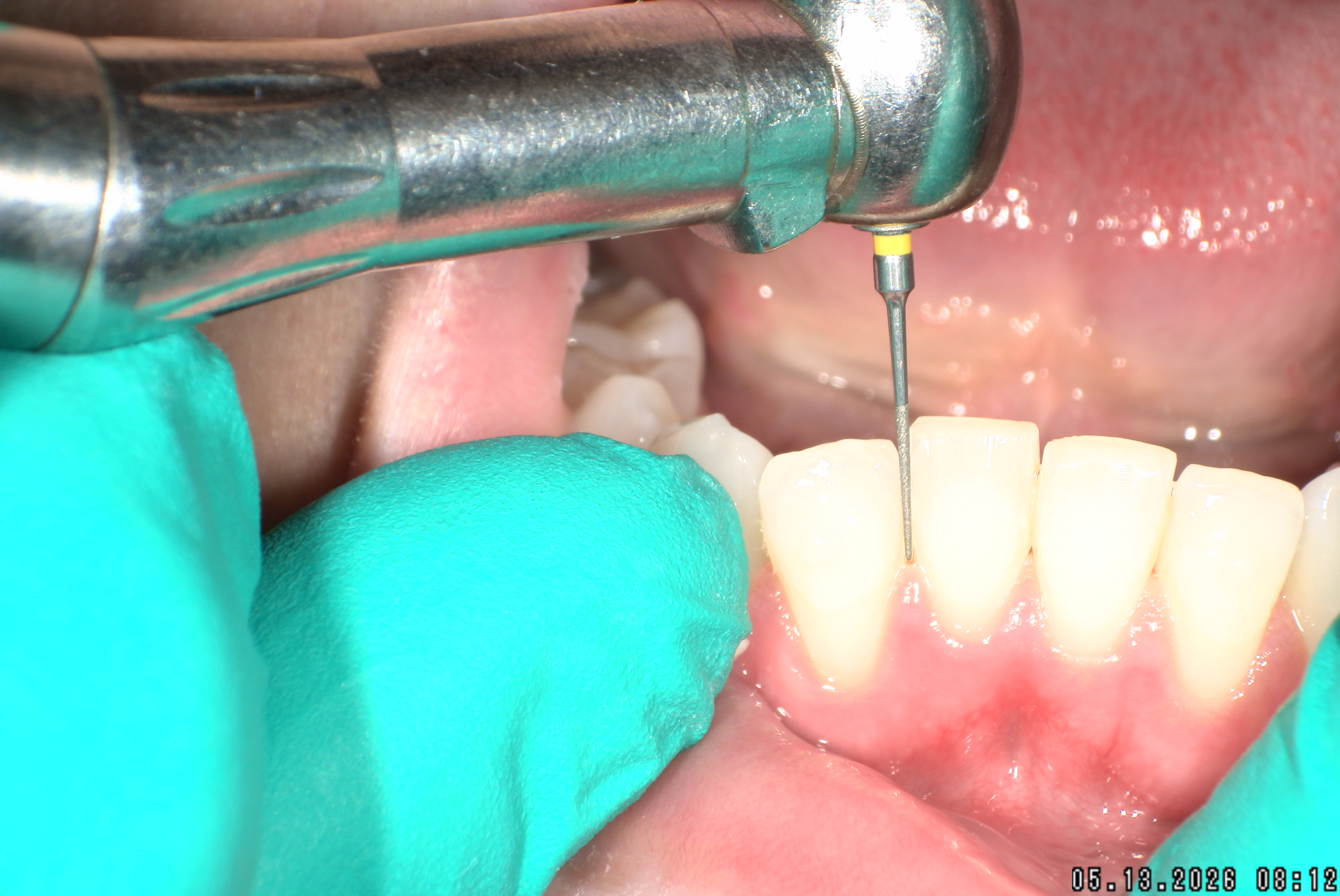 Watson-ProxiBur for Clear Aligner Treatment-image