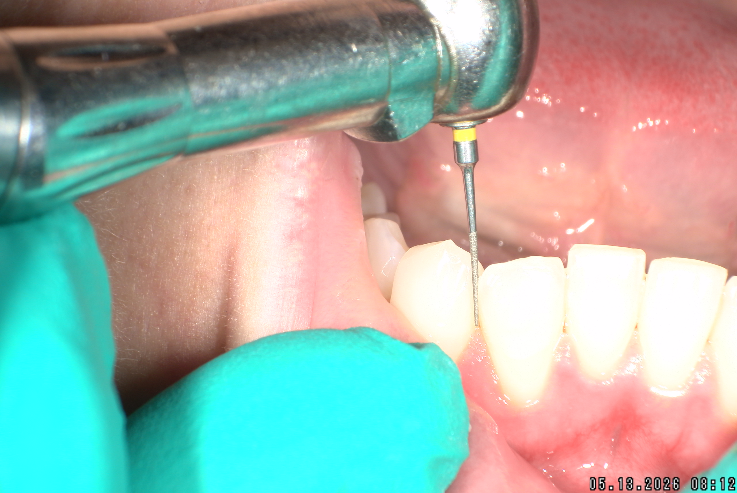 Watson-ProxiBur for Clear Aligner Treatment-image