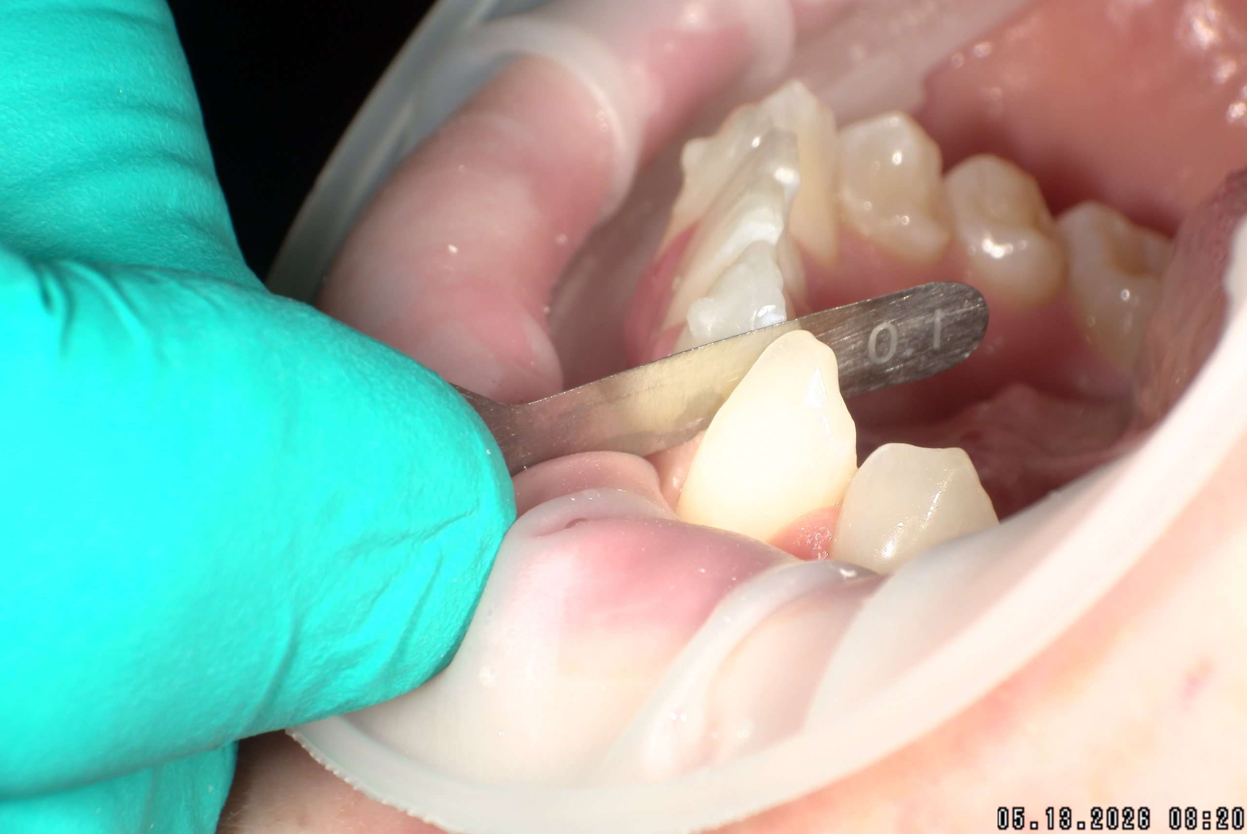 Watson-ProxiBur for Clear Aligner Treatment-image
