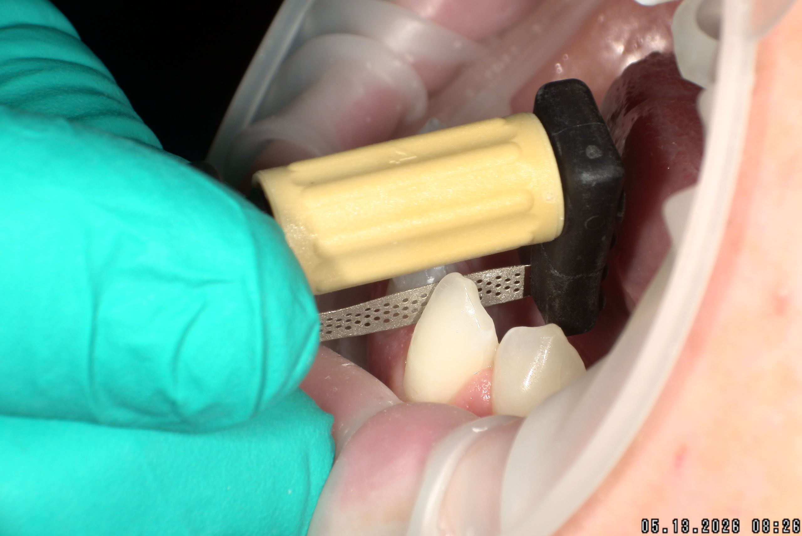 Watson-ProxiBur for Clear Aligner Treatment-image