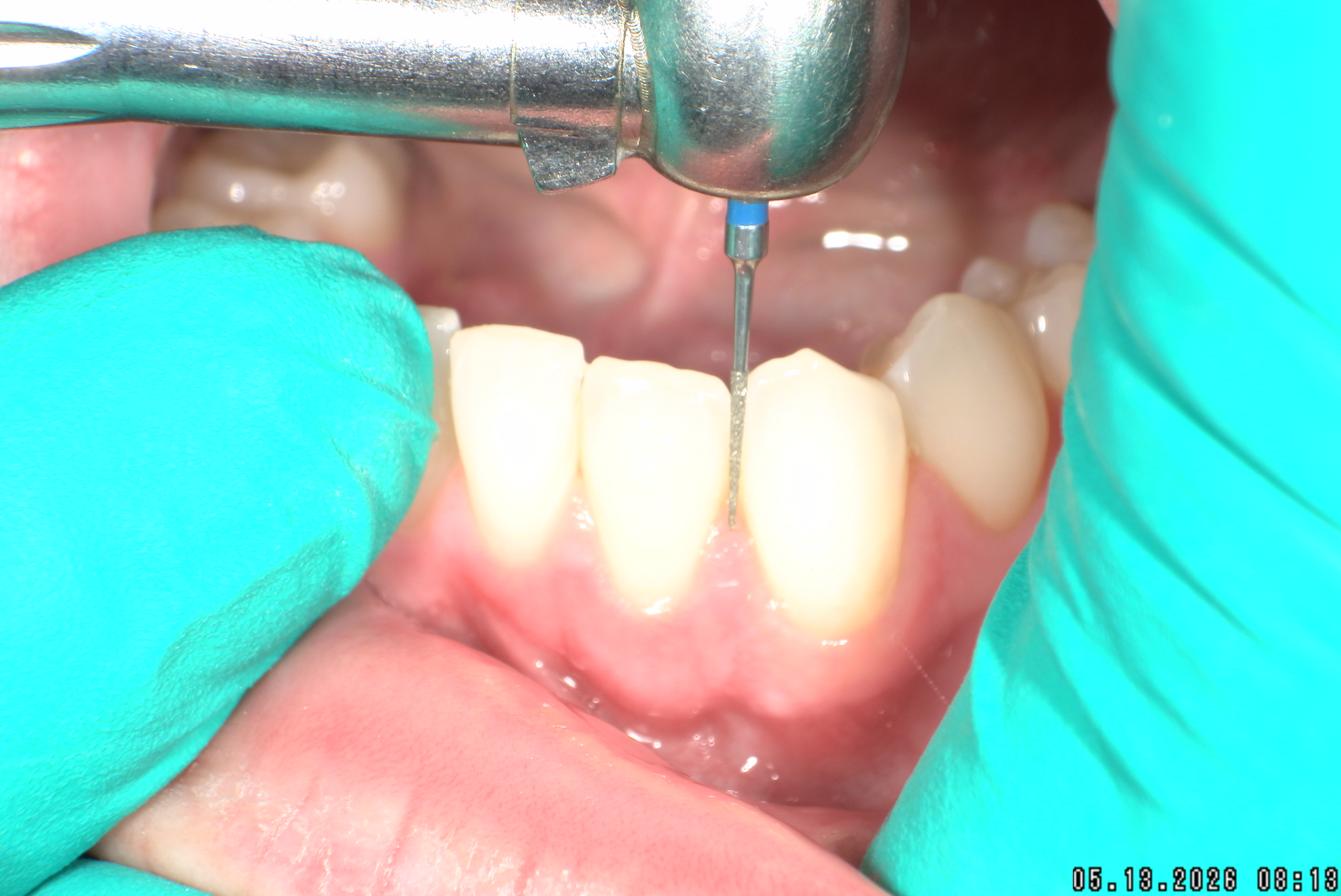 Watson-ProxiBur for Clear Aligner Treatment-image