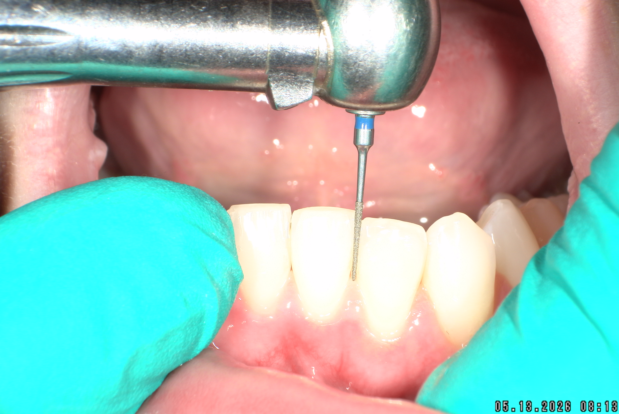 Watson-ProxiBur for Clear Aligner Treatment-image