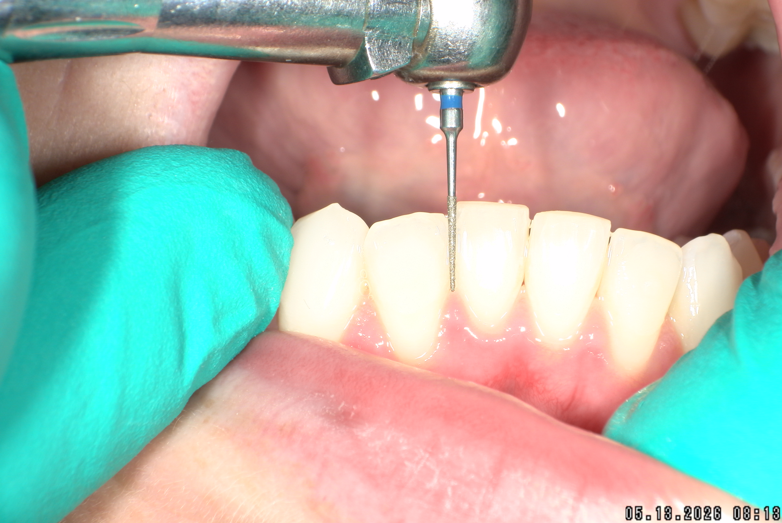 Watson-ProxiBur for Clear Aligner Treatment-image