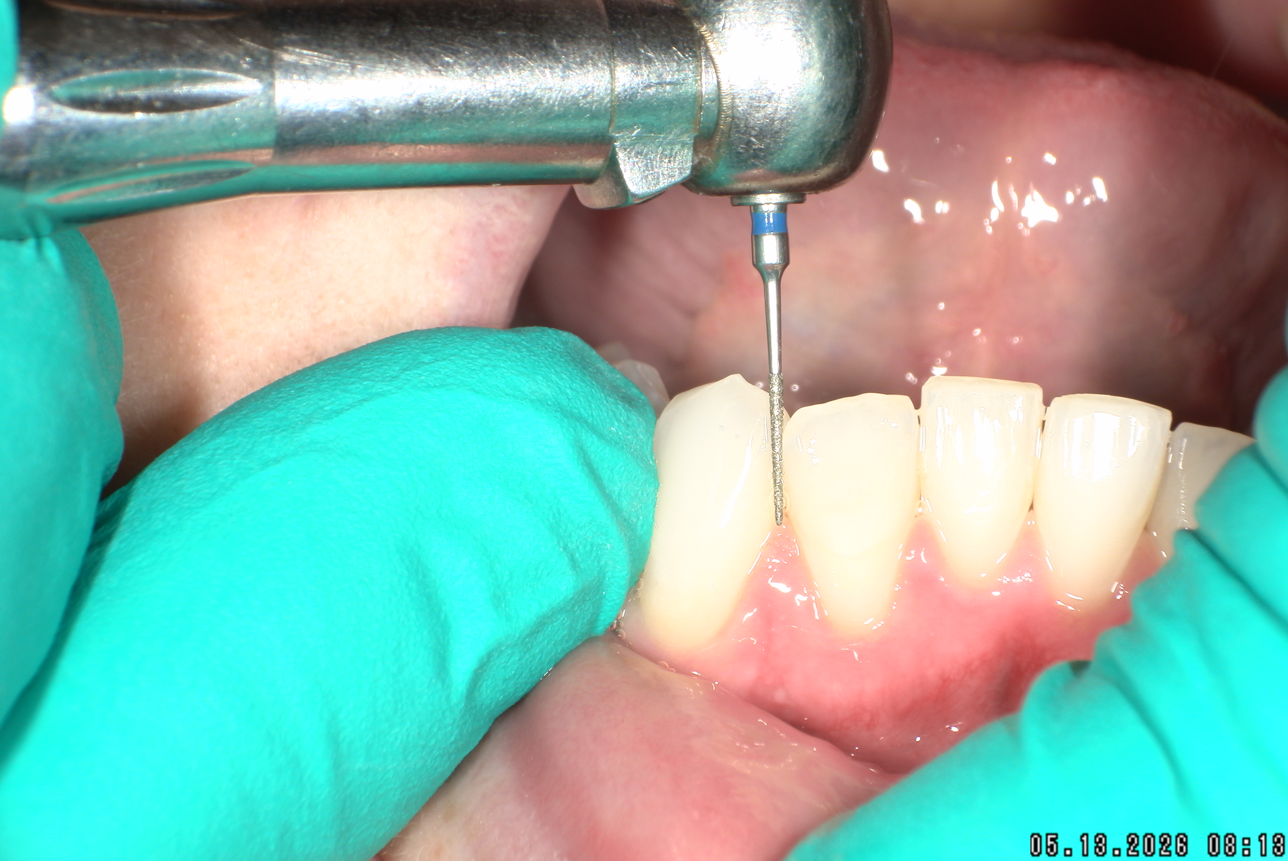 Watson-ProxiBur for Clear Aligner Treatment-image