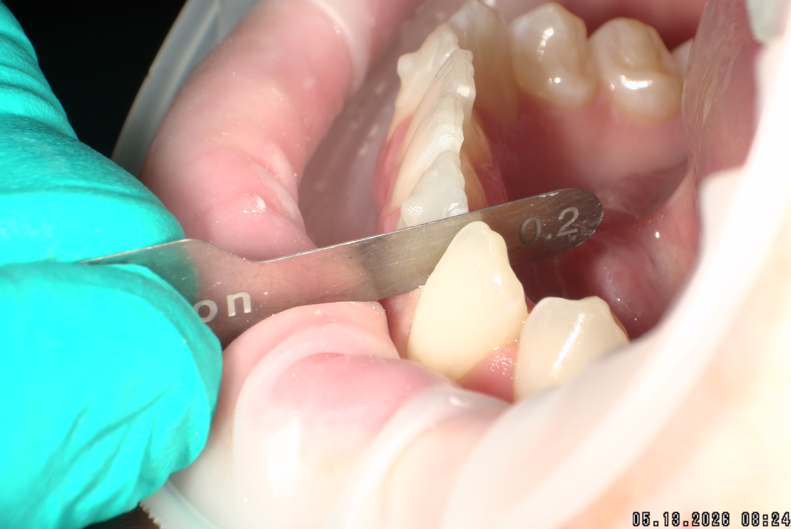 Watson-ProxiBur for Clear Aligner Treatment-image