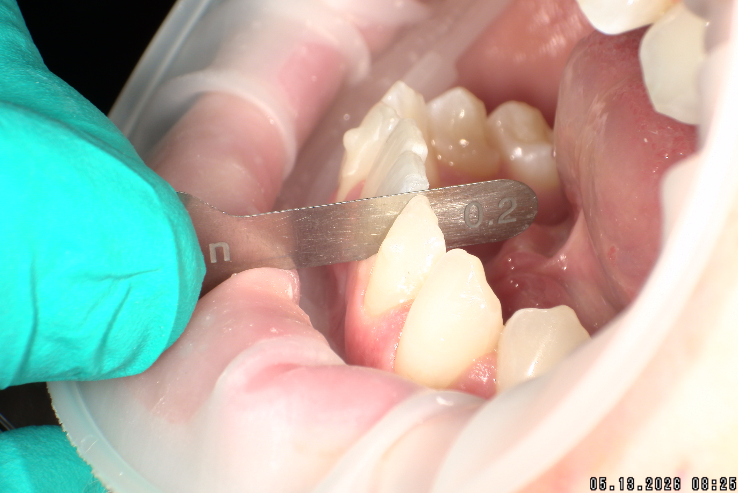 Watson-ProxiBur for Clear Aligner Treatment-image