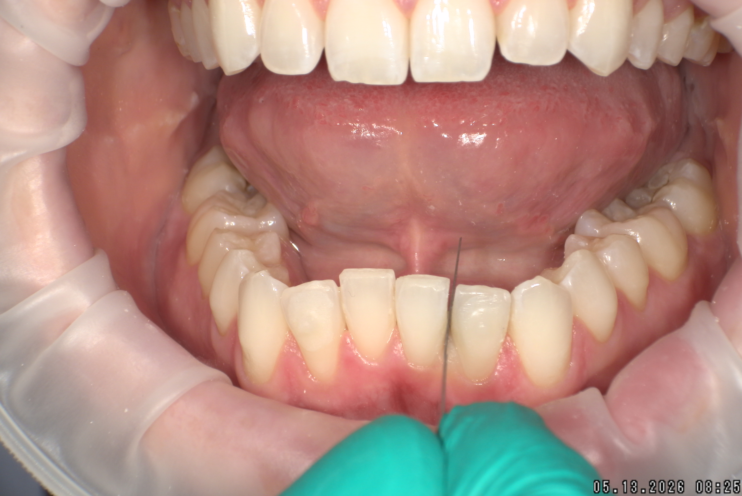 Watson-ProxiBur for Clear Aligner Treatment-image