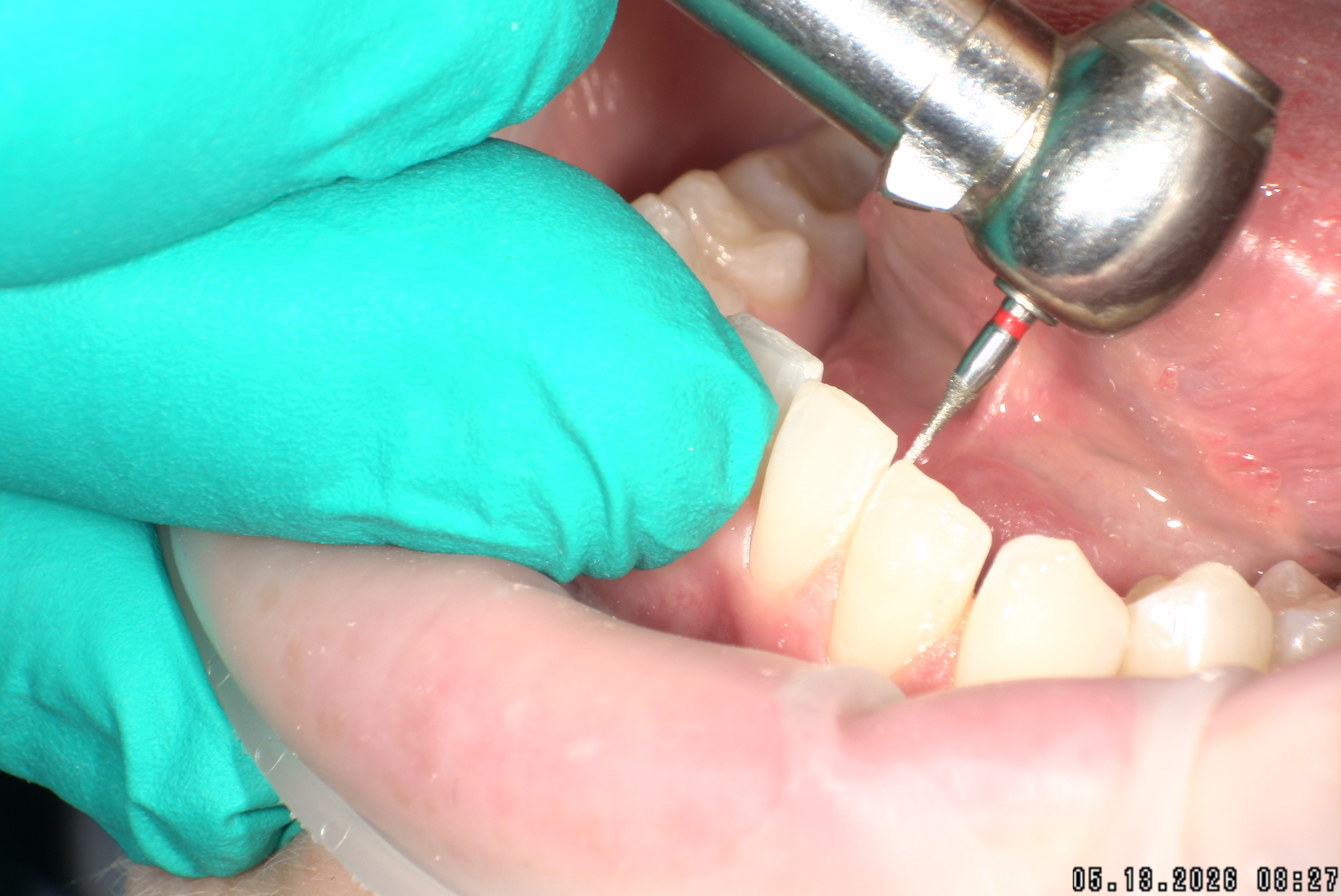 Watson-ProxiBur for Clear Aligner Treatment-image