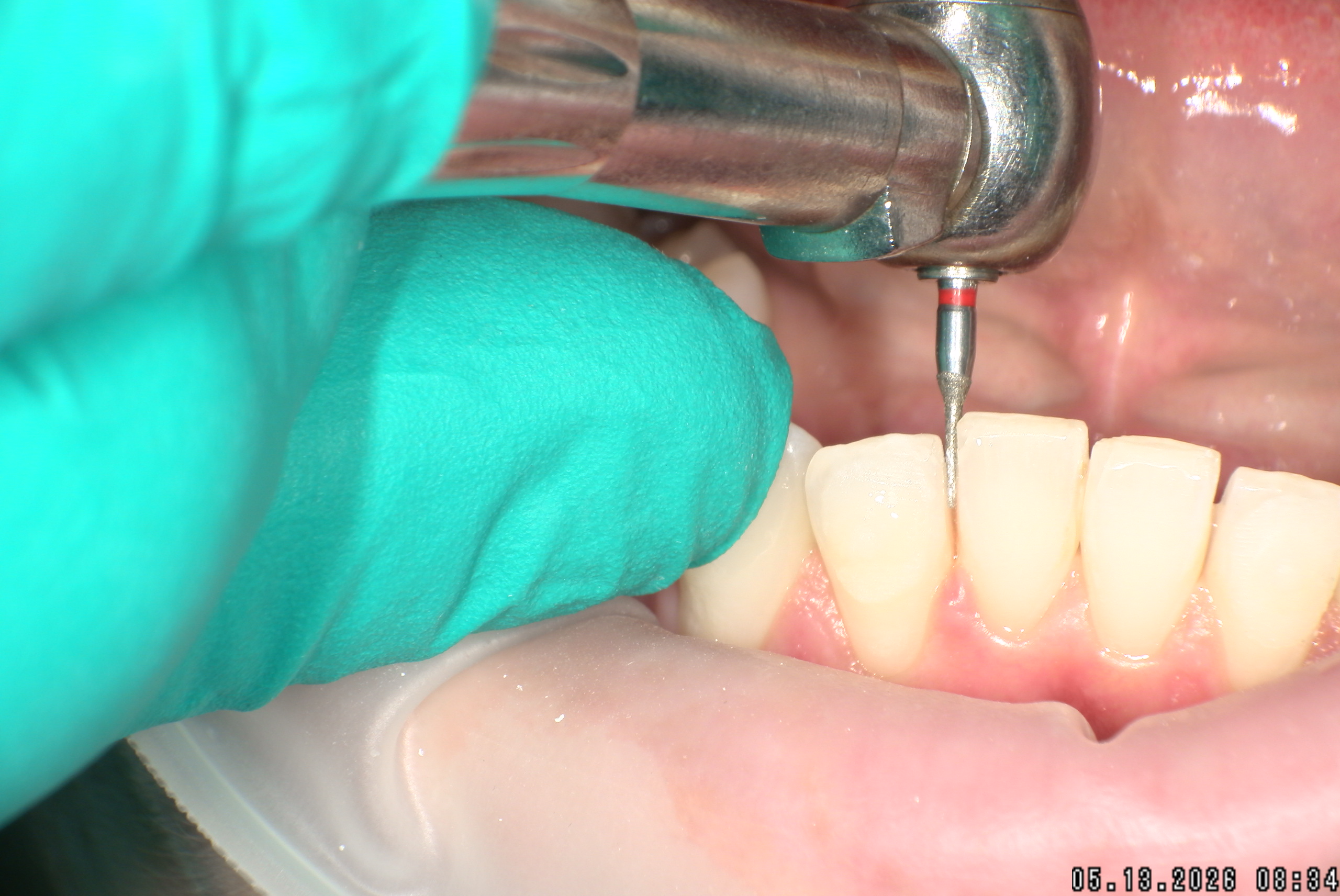 Watson-ProxiBur for Clear Aligner Treatment-image
