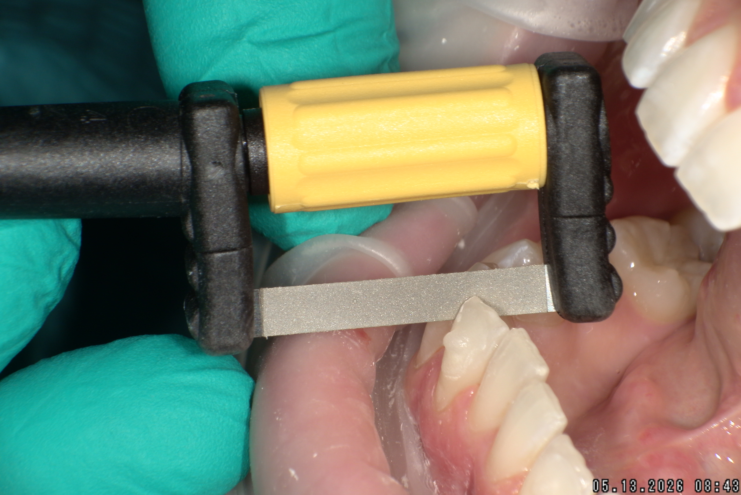 Watson-ProxiBur for Clear Aligner Treatment-image