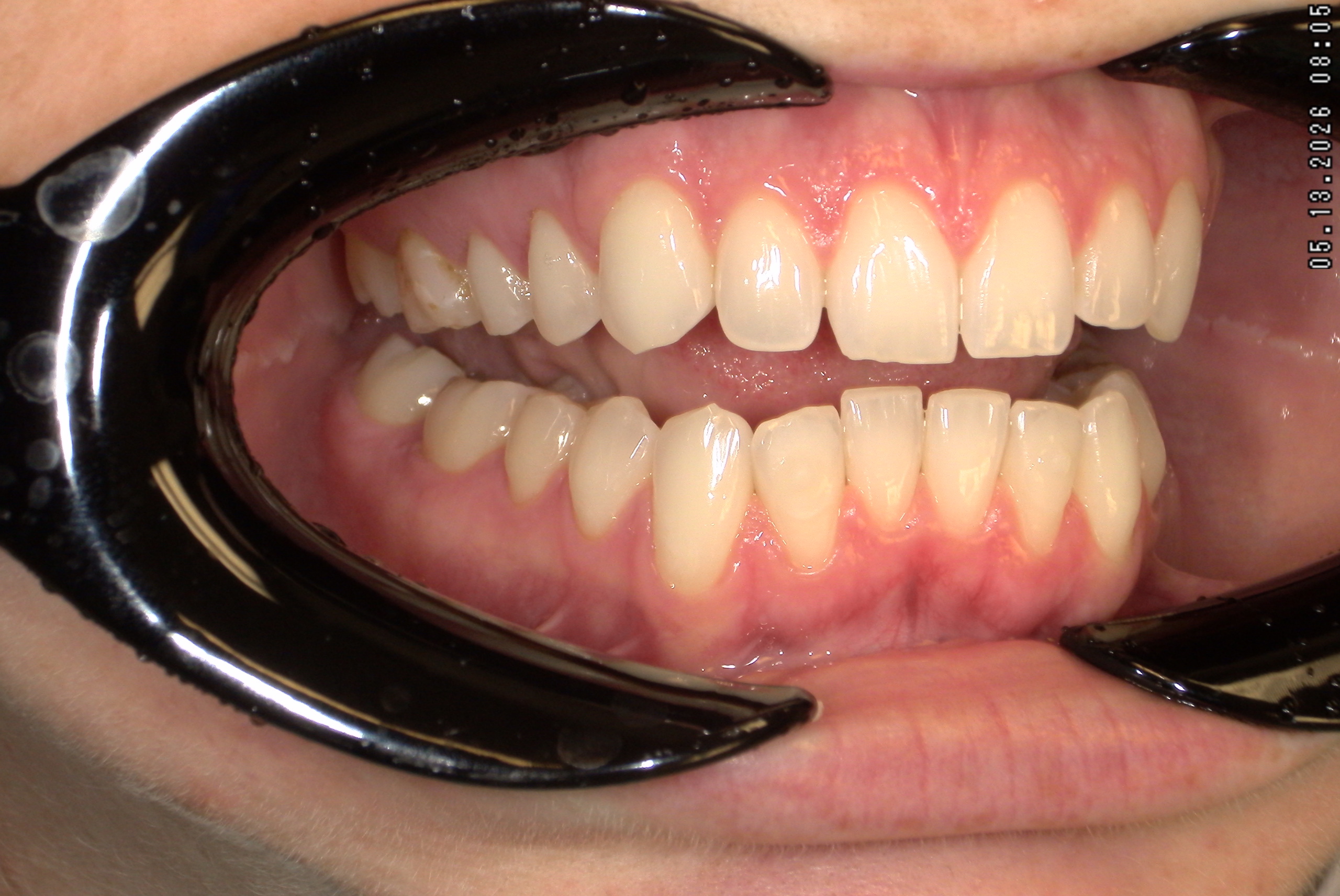 Watson-ProxiBur for Clear Aligner Treatment-image