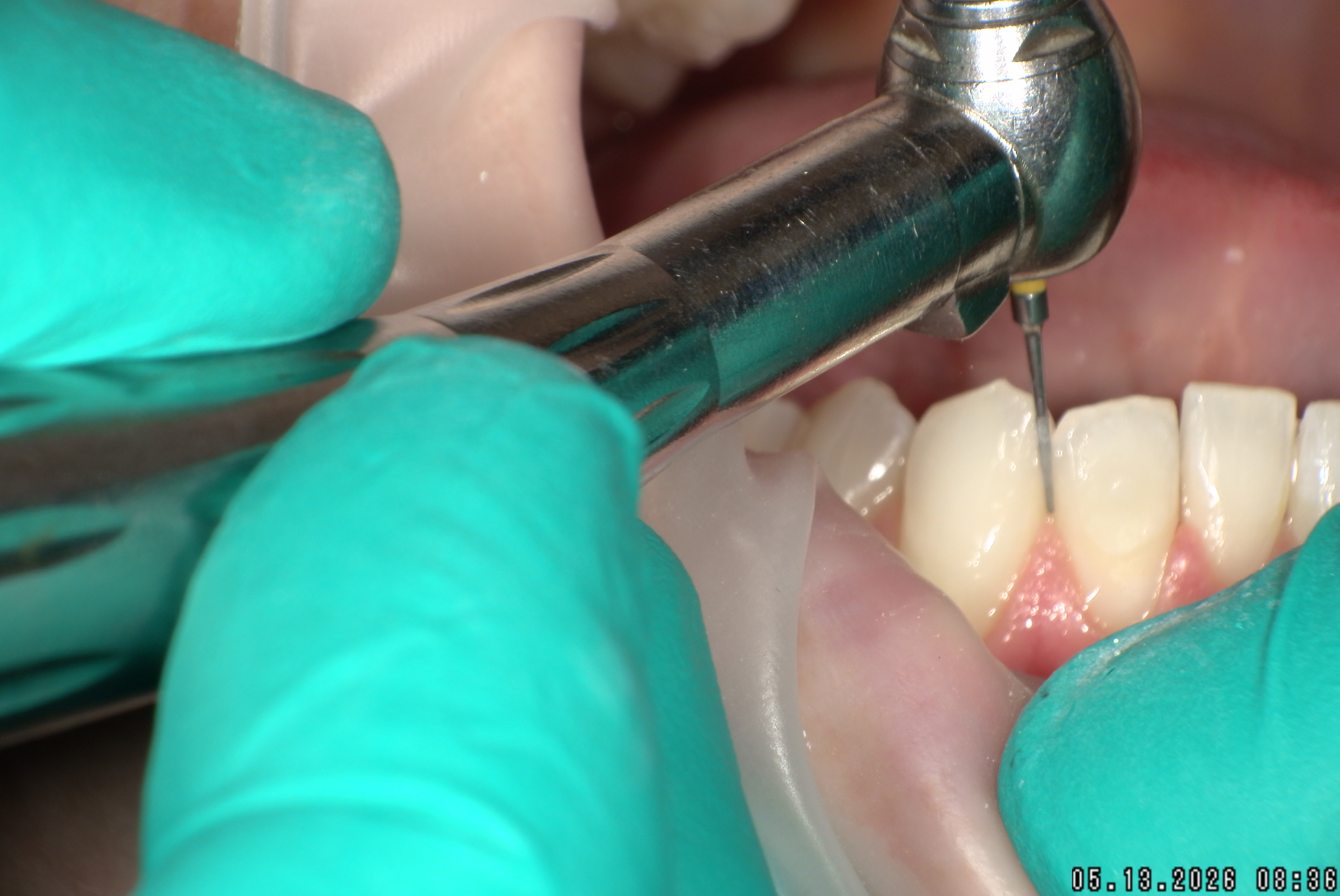 Watson-ProxiBur for Clear Aligner Treatment-image