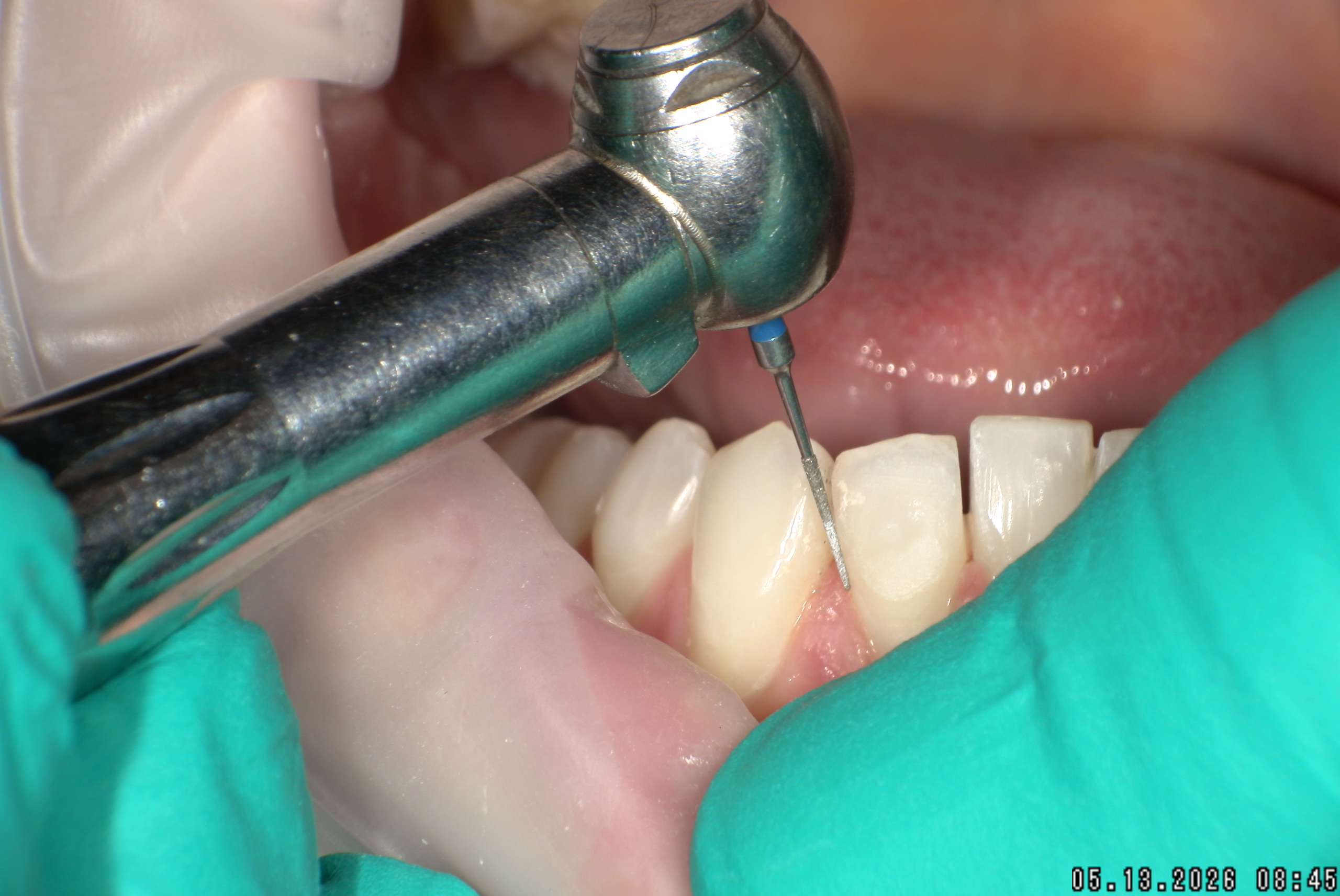 Watson-ProxiBur for Clear Aligner Treatment-image