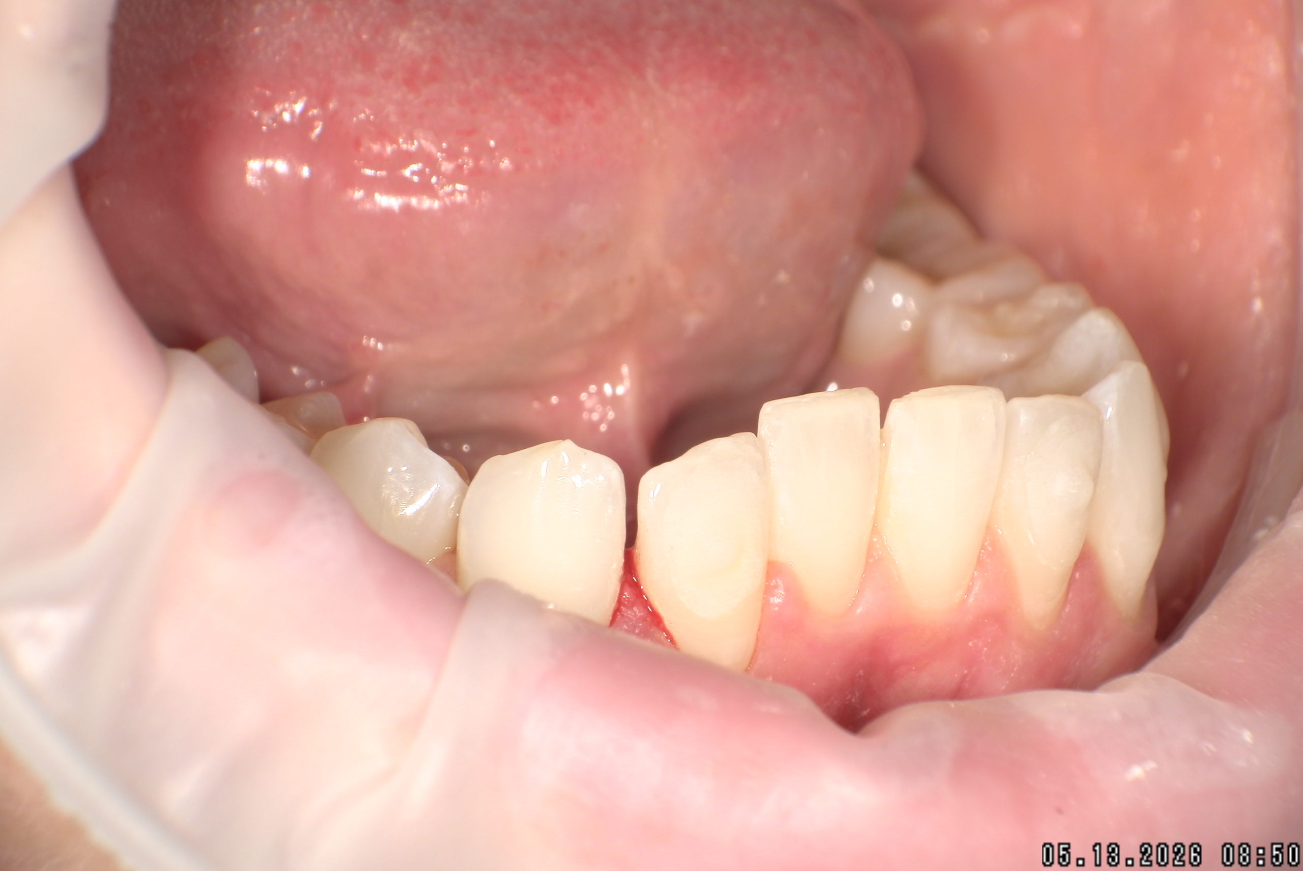 Watson-ProxiBur for Clear Aligner Treatment-image
