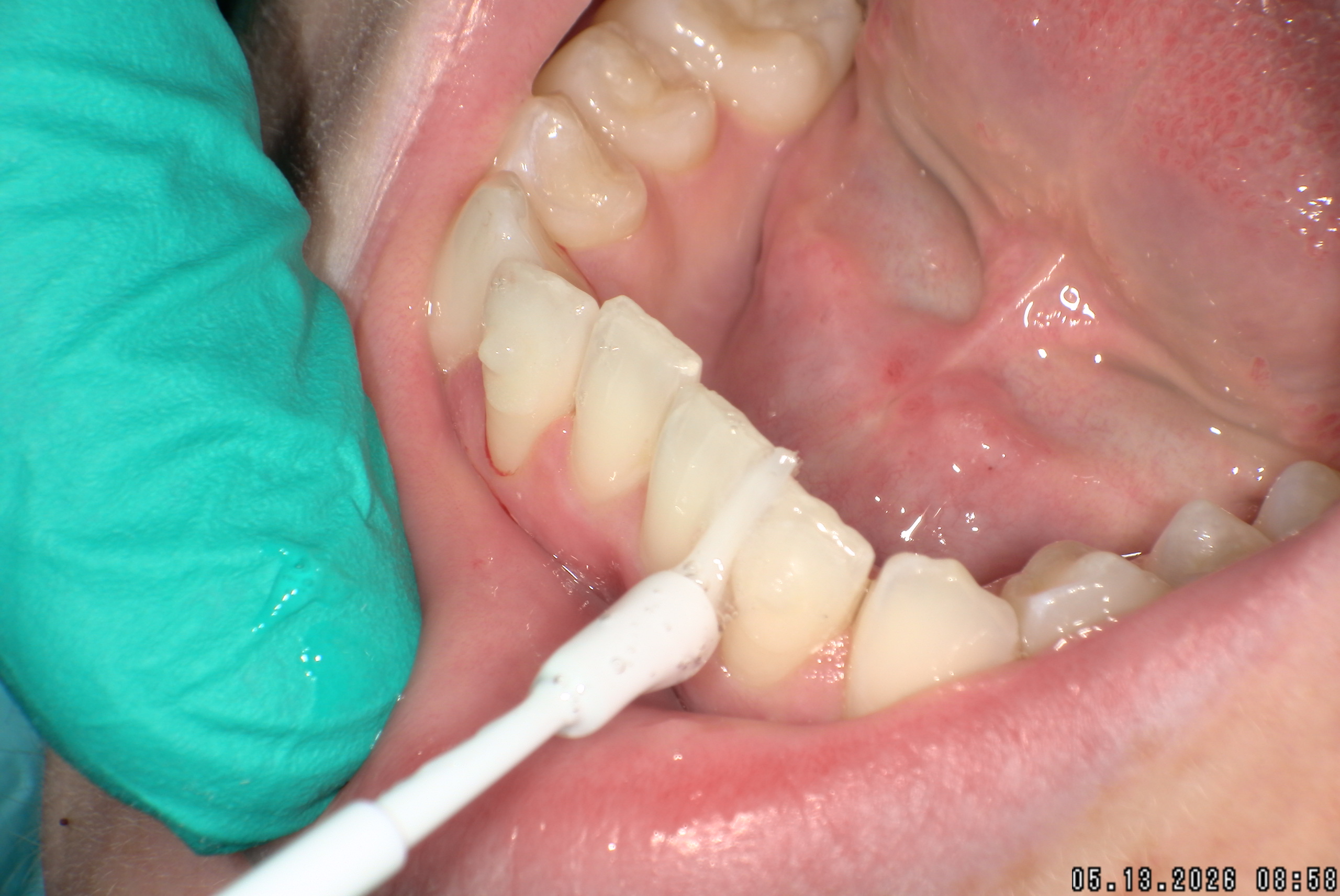 Watson-ProxiBur for Clear Aligner Treatment-image