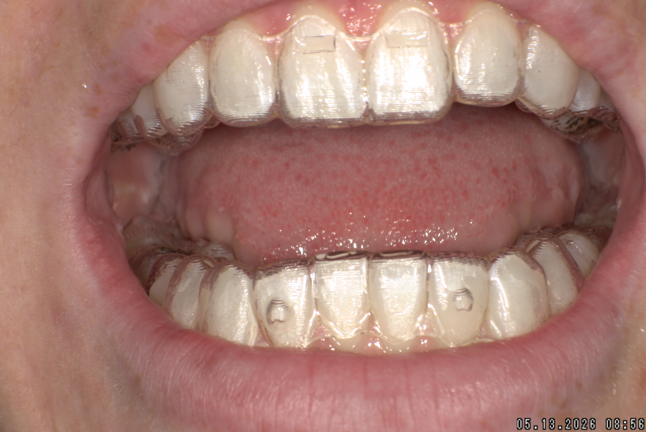 Watson-ProxiBur for Clear Aligner Treatment-image