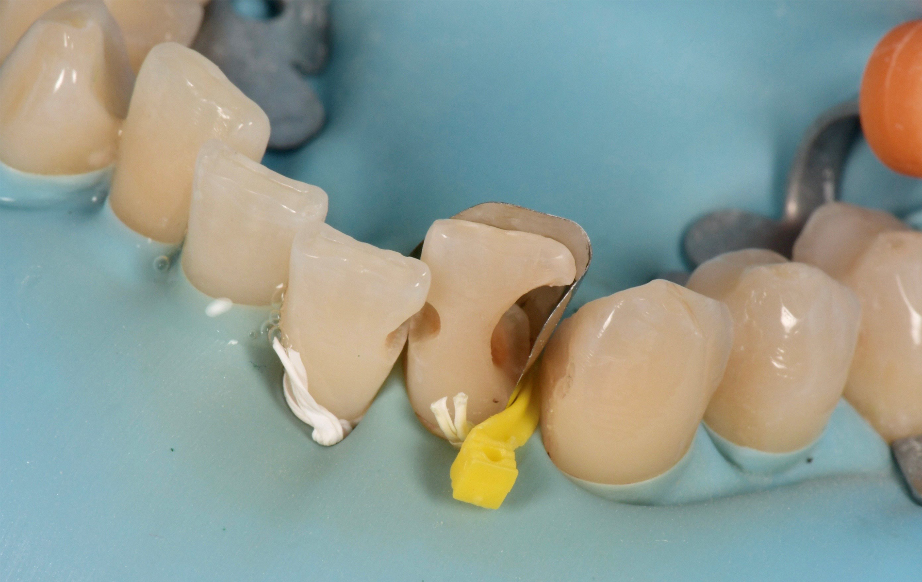Fusion Anterior