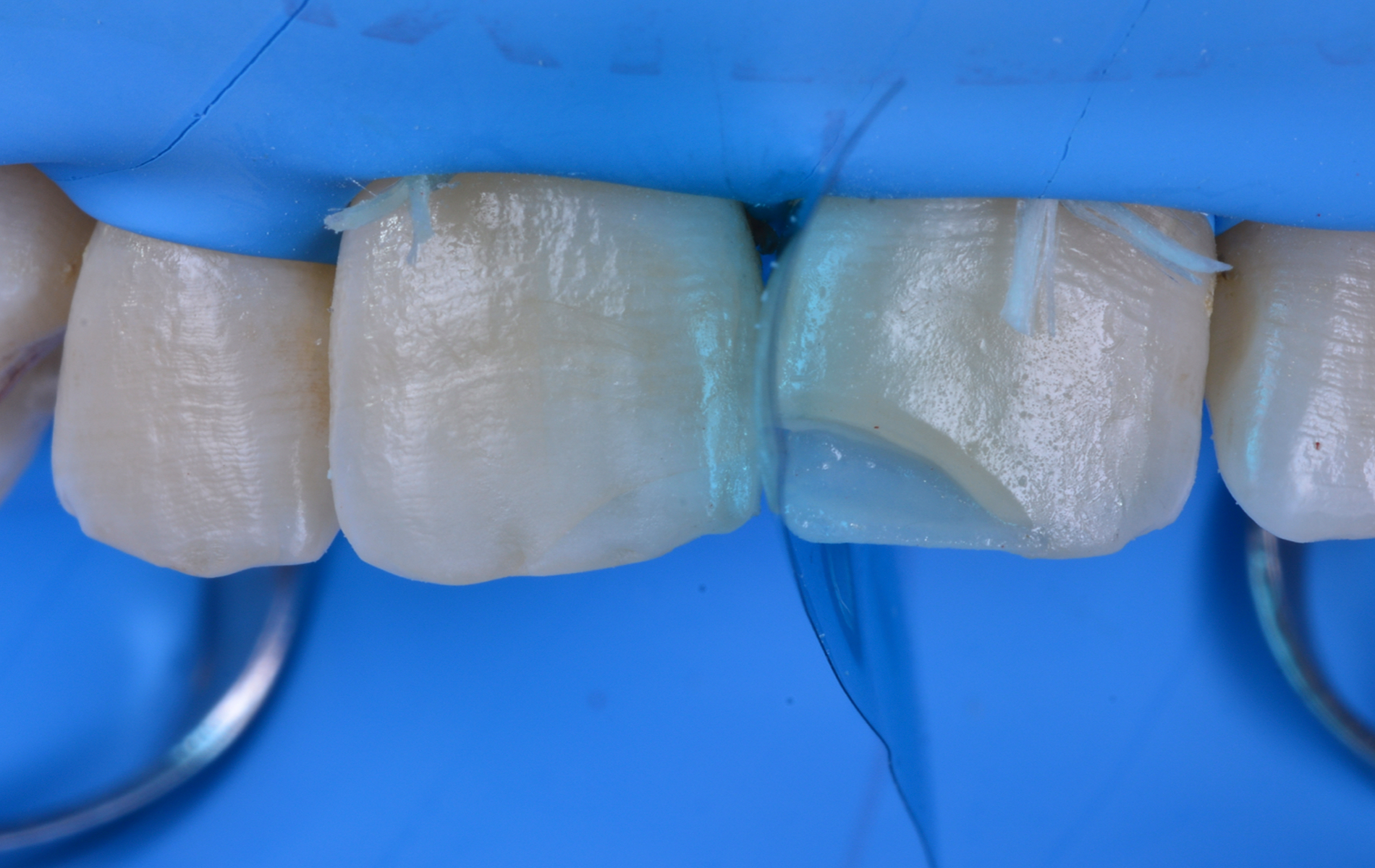 varistrip case study