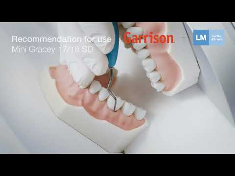 Mini Gracey 17/18 Curette | Distal Surfaces, Sharper Angulation