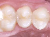 Strata-G Teeth Before