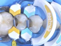 Strata-G Yellow and Blue Matrix Bands