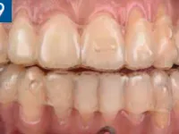 Clear Aligners