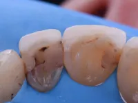 Fusion Teeth Before