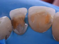 Fusion teeth before