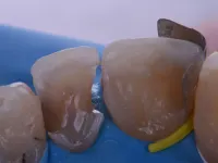 Fusion Wedge inserted