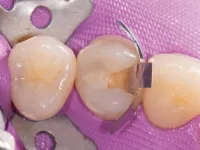 MO Prep on tooth