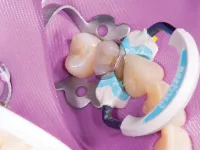 Strata-G Blue Ring 