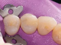 Composite restoration right after Strata-G ring removal