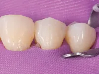 Strata-G Final Product after polish