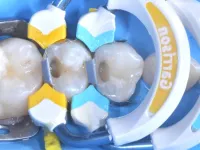 Strata-G™ yellow and blue matrix rings