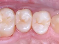 Occlusal vision of restoration