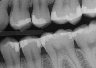 BurtonMatt_pre op xray_012025 Figure 1b