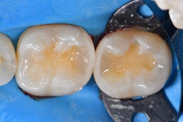 Occlusal microlayering completed using Simplishade Bulk Flow