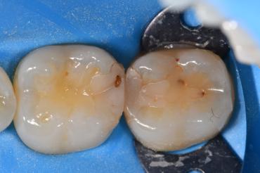 Pre-operative view of failing restorations on #30DO and 31MO