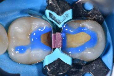 Selective enamel etching using Ultra-etch (Ultradent Products).