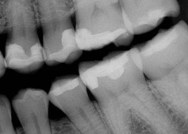 Post-operative control bitewing radiograph.