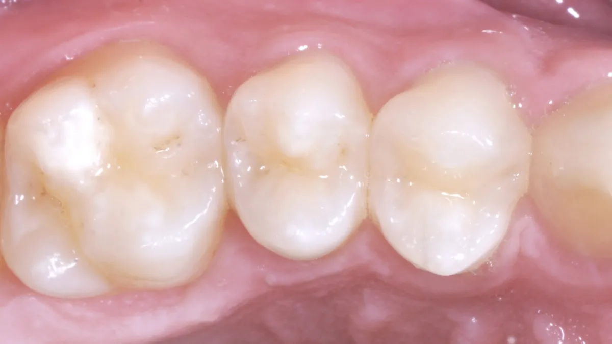 Strata-G Teeth Before