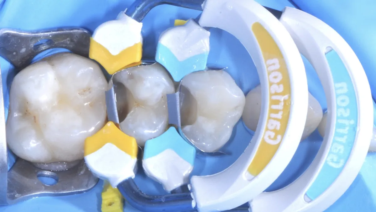 Strata-G Yellow and Blue Matrix Bands