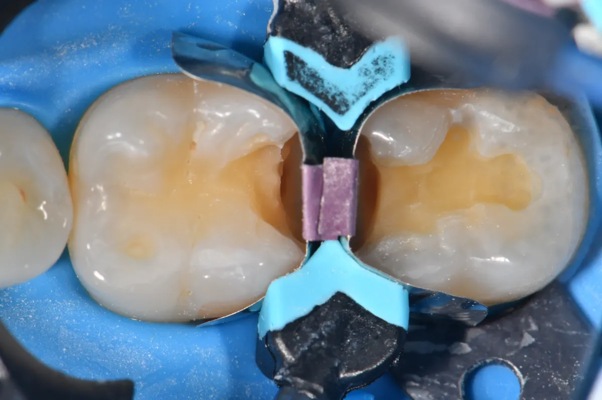 The Quad system-specific tension ring in place, showing the arrow on the lingual aspect driving between the tines of the bifid wedge.