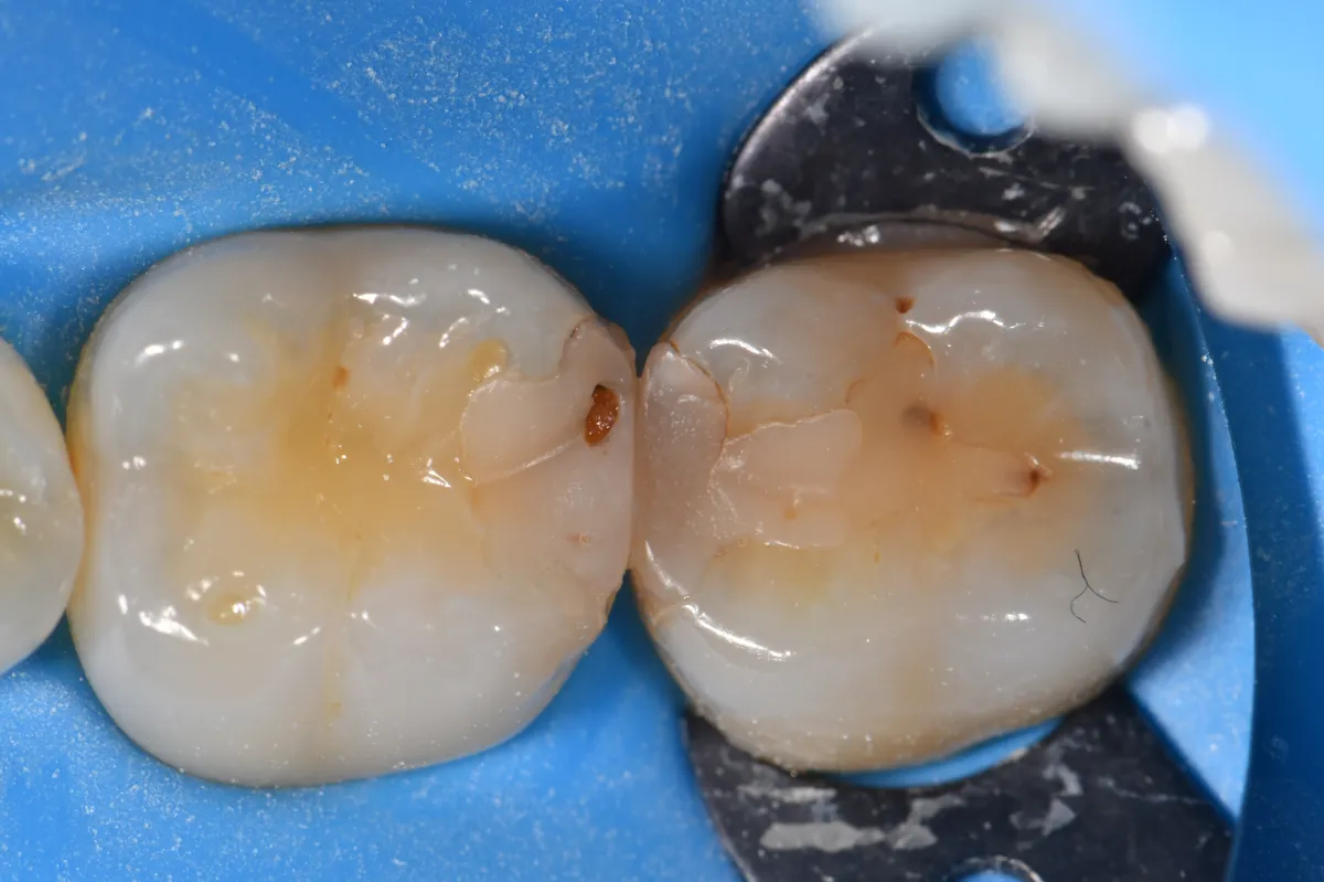 Pre-operative view of failing restorations on #30DO and 31MO