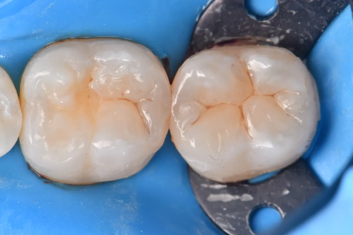 Final occlusal layering result using the oblique, successive cusp buildup technique as per Deliperi and Bardwell (1)