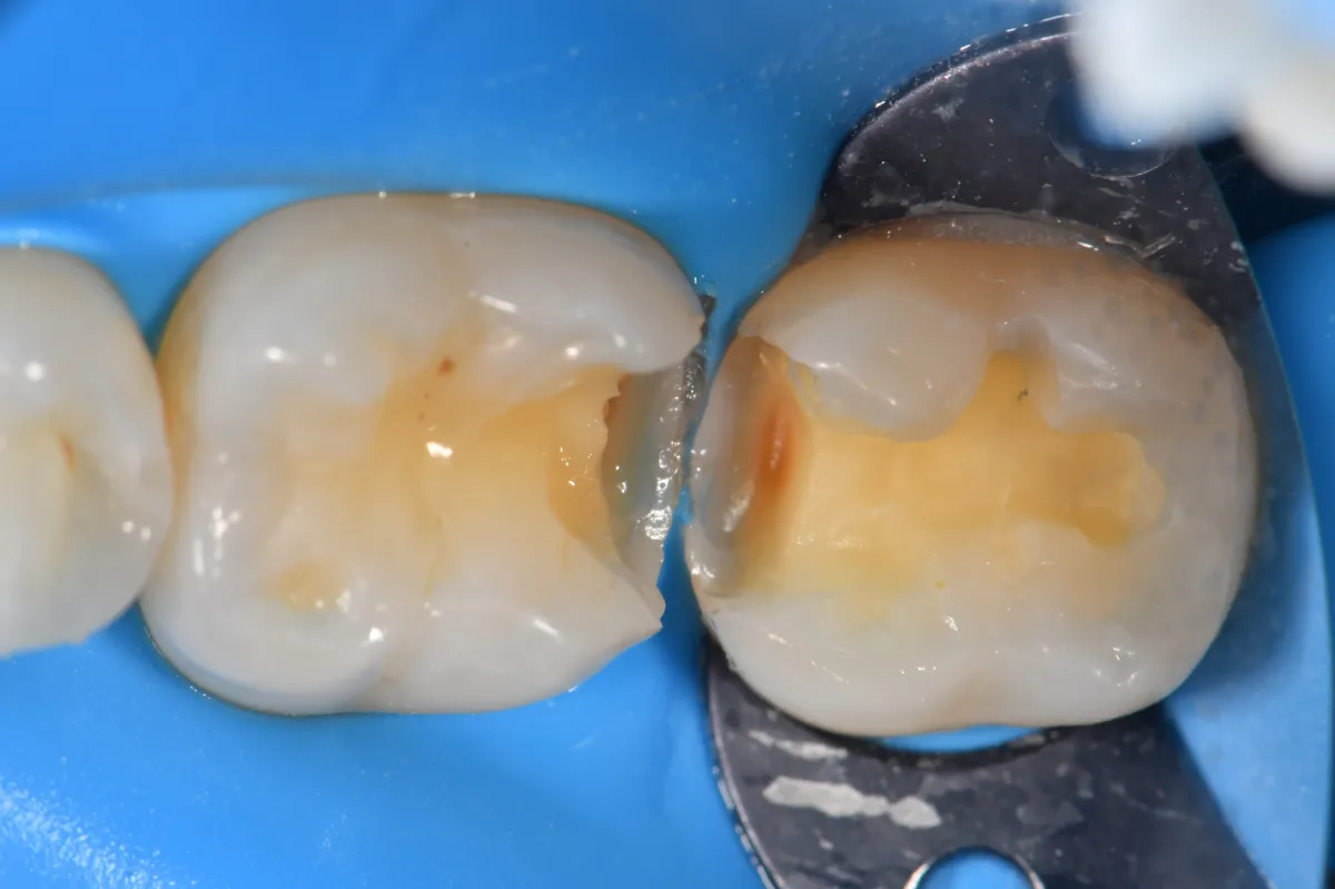 Intraoperative view with restorations removed, caries excavated.