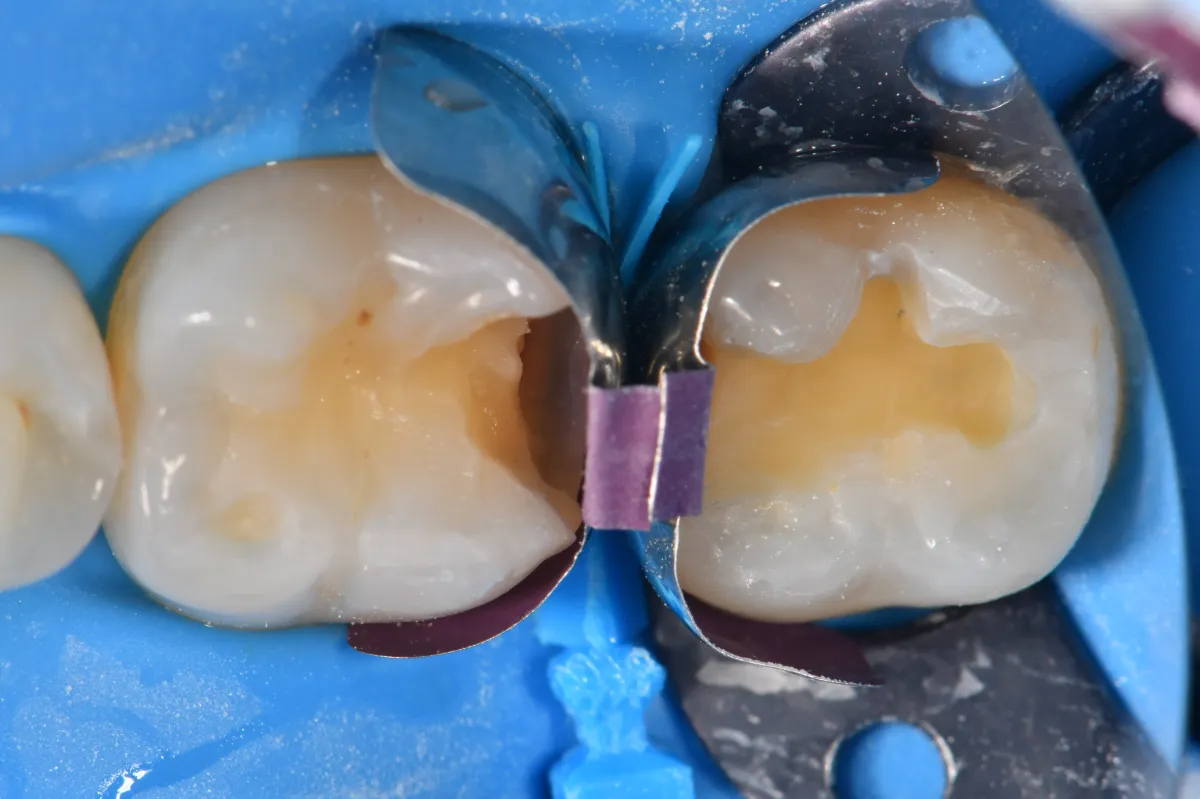 Post micro particle abrasion, Garrison Firm Bands were set-up in a back-to-back fashion, secured interdentally by the bifid wedge of the Quad Matrix system.