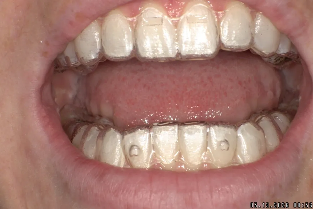 Patient Wearing Tray
