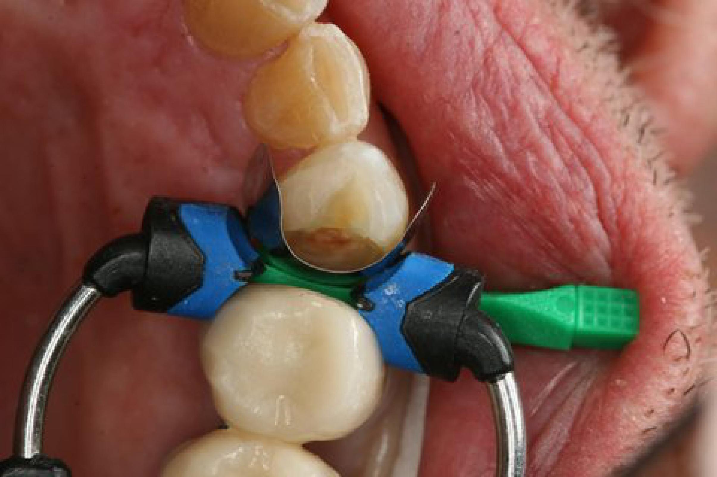 BRACELET en or jaune (750), à cinq rangs alternés